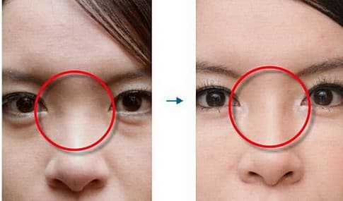 Nasal corrector Nasal corrector