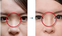 Corector Nazal Corector Nazal