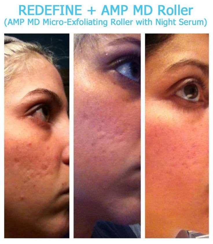 Magic Roller - device for mesotherapy, acne, wrinkles, and fine lines Magic Roller - device for mesotherapy, acne, wrinkles, and fine lines