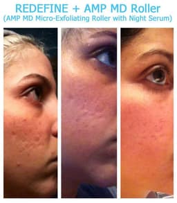 Magic Roller - device for mesotherapy, acne, wrinkles, and fine lines Magic Roller - device for mesotherapy, acne, wrinkles, and fine lines