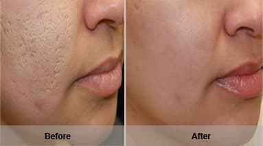 Magic Roller - device for mesotherapy, acne, wrinkles, and fine lines Magic Roller - device for mesotherapy, acne, wrinkles, and fine lines