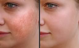 Magic Roller - device for mesotherapy, acne, wrinkles, and fine lines Magic Roller - device for mesotherapy, acne, wrinkles, and fine lines