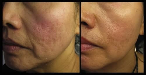 Magic Roller - device for mesotherapy, acne, wrinkles, and fine lines Magic Roller - device for mesotherapy, acne, wrinkles, and fine lines