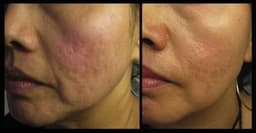 Magic Roller - device for mesotherapy, acne, wrinkles, and fine lines Magic Roller - device for mesotherapy, acne, wrinkles, and fine lines